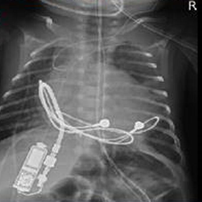 X-ray of 28-week-old infant with tiny pacemaker implanted by specialists at Norton Children's Heart Institute